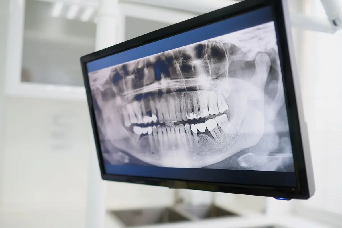 Radiografie panoramică dentară afișată pe monitor