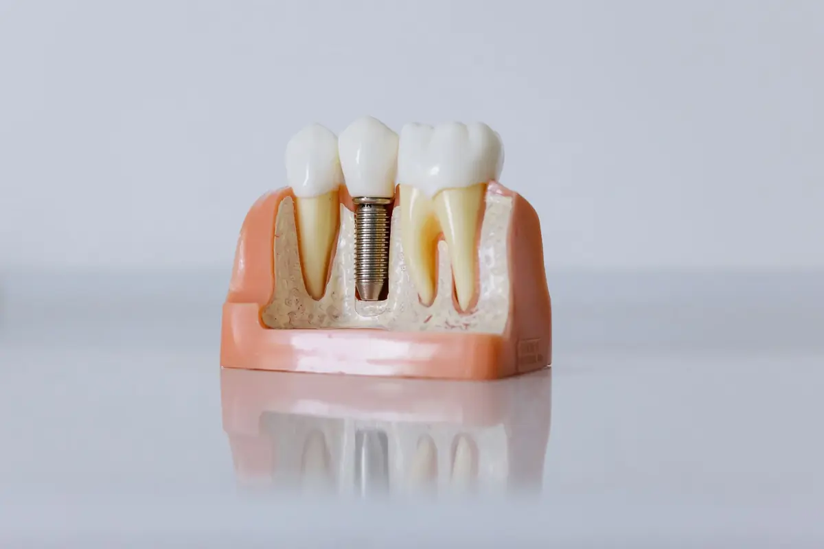 Model didactic al unui implant dentar între doi dinți naturali
